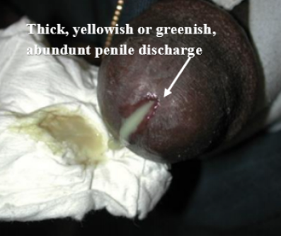 Male gonorrhea symptom awareness image