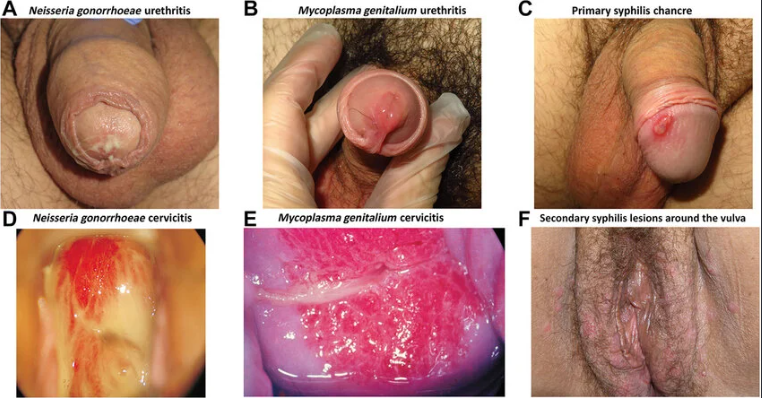 Gonorrhea symptoms educational image